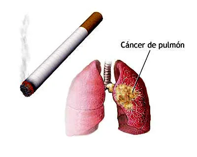 Cáncer-Pulmón-2